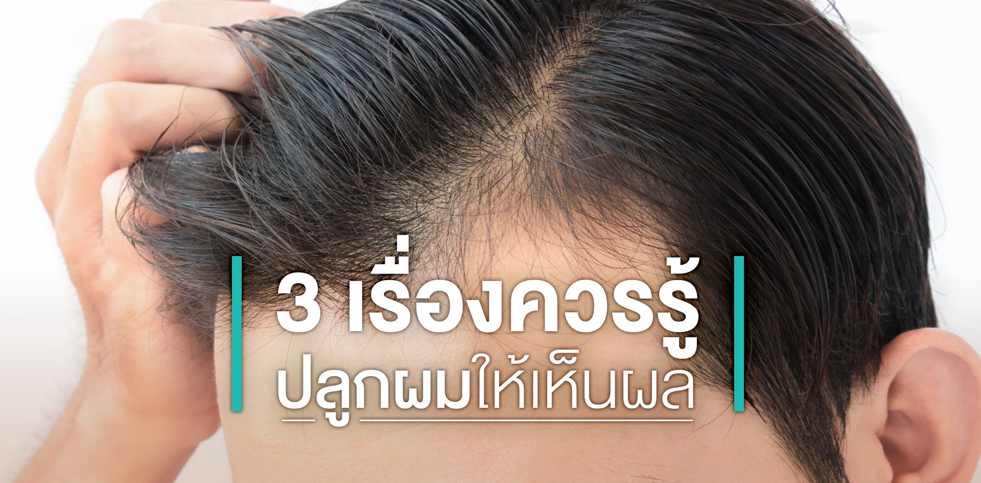 3 เรื่องควรรู้ ถ้าหัวล้านแล้วคิดอยากจะปลูกผมให้เห็นผลดีที่สุด