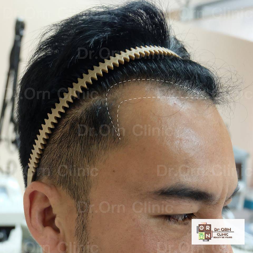 à¸£ à¸§ à¸§ Dr Orn Hair Transplant Center à¹à¸™à¸§à¸œà¸¡à¹ƒà¸«à¸¡ à¸«à¸¥ à¸‡à¸›à¸¥ à¸ 6à¹€à¸