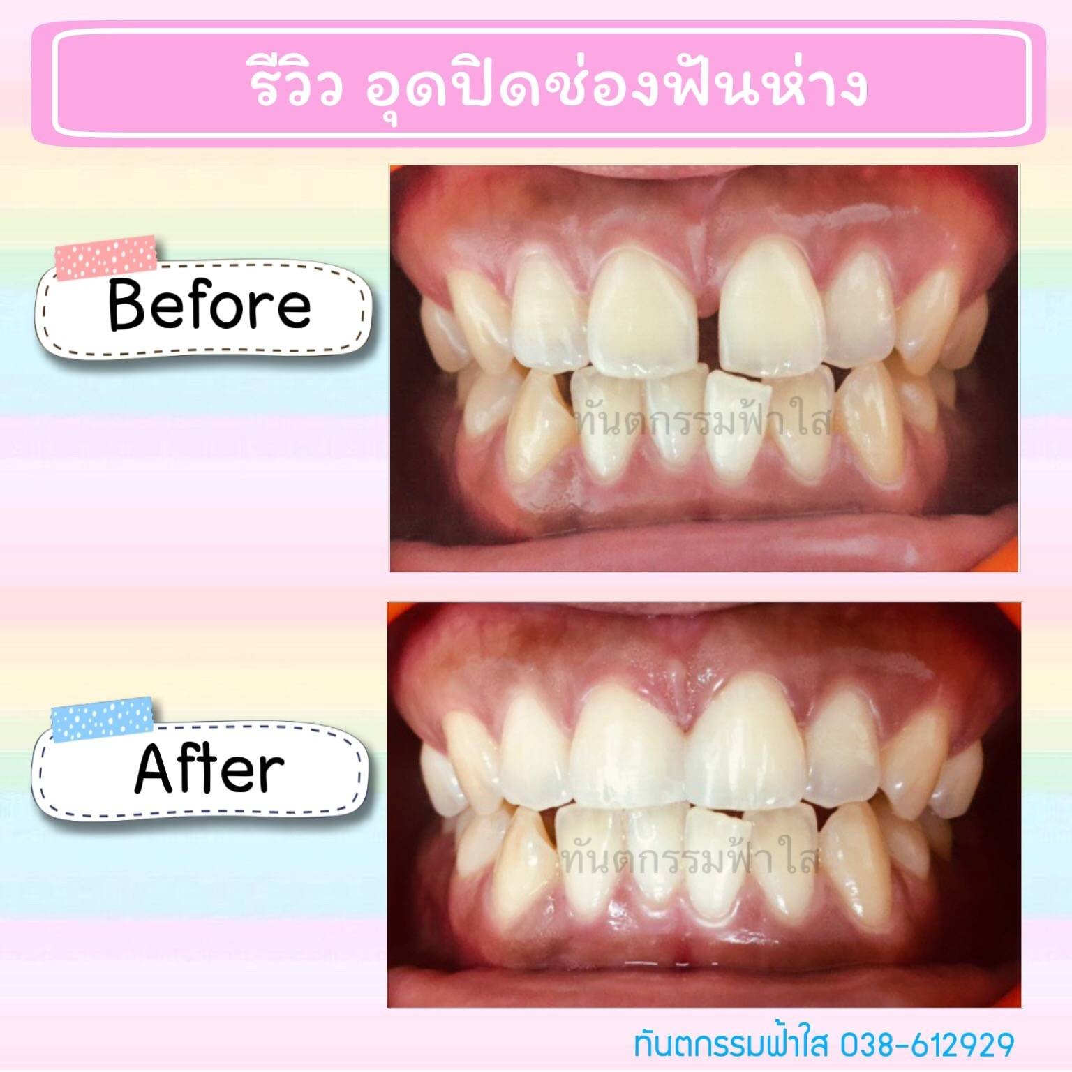 รีวิว คลินิกทันตกรรมฟ้าใส ระยอง - มองหาคลินิกทำฟัน แนะนำมาที่คลินิกทันตกรรมฟ้าใส  คุณหมอใจดีมาก จัดฟันผ่อนจ่ายได้ อุดฟันห่าง ตัดเหงือก ราคาไม่แพง