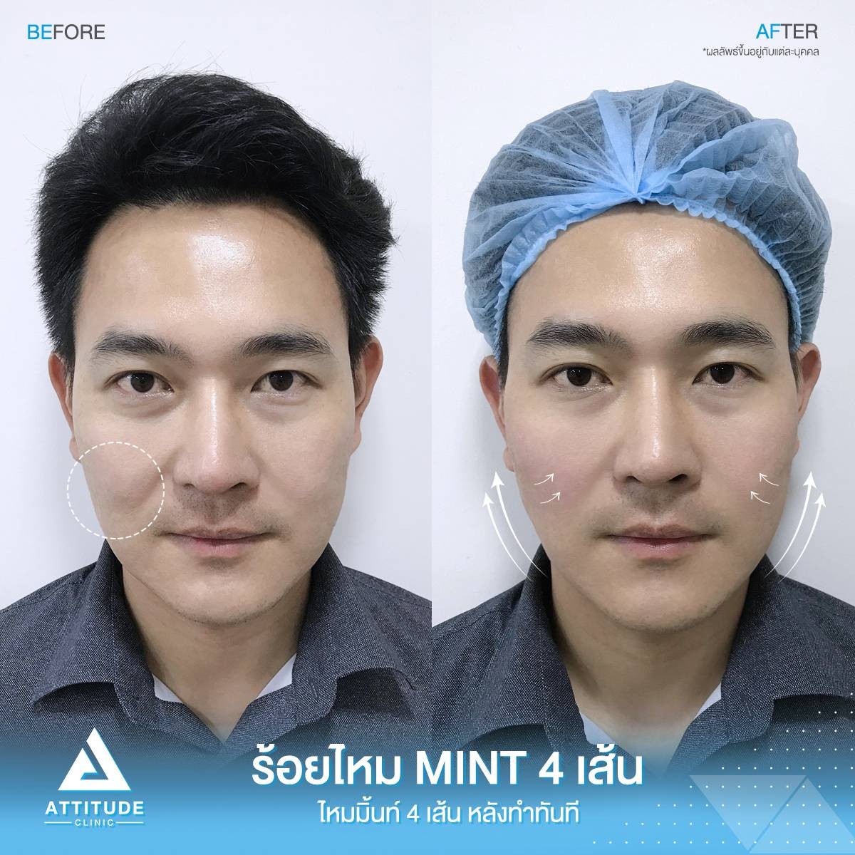 รีวิว Attitude Clinic ห้วยขวาง รีวิวร้อยไหมมิ้นท์ Mint Lift จำนวน 4 เส้น ช่วงหน้าแก้มและร่องแก้ม 9487