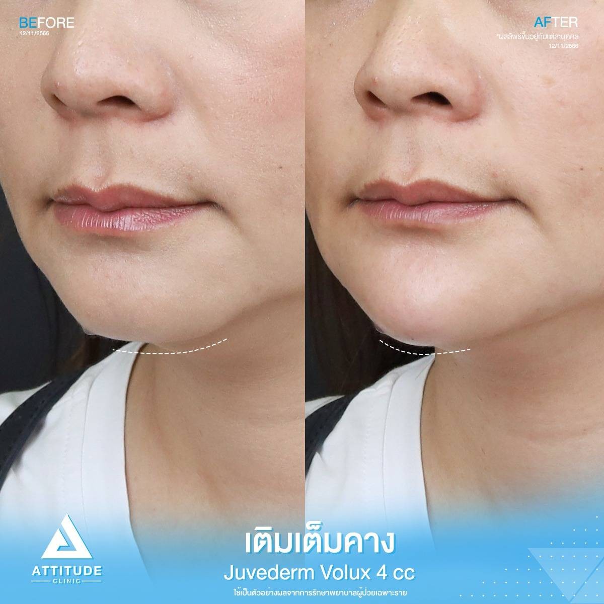 รีวิว Attitude Clinic ลำปาง รีวิวโปรแกรมฉีดฟิลเลอร์คาง Juvederm Volux จำนวน 4 Cc ของคุณยุว