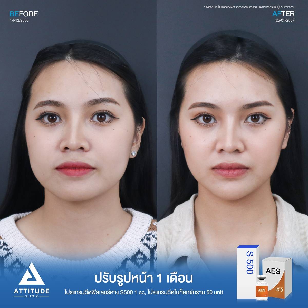 รีวิว Attitude Clinic เชียงใหม่ รีวิวโปรแกรมฉีดฟิลเลอร์คาง รุ่น S5001 Cc และโปรแกรมฉีดโบท็อก