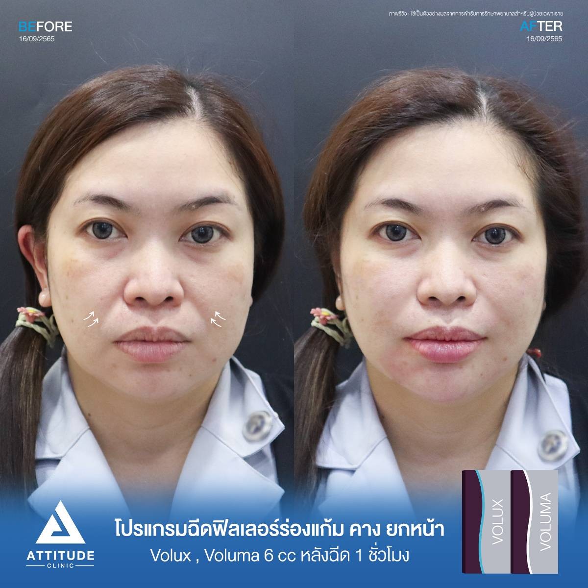 รีวิว Attitude Clinic เชียงใหม่ รีวิวโปรแกรมฉีดฟิลเลอร์ร่องแก้ม คาง ยกหน้ารุ่น Volux และ