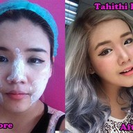 Before-After ประมาณ 1 เดือน หน้ากระชับขึ้นมากกก เห็นเป็นรูปหน้ามากขึ้น ชอบมากกก 