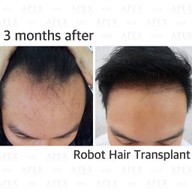 Apex Profound Beauty ทองหล่อ