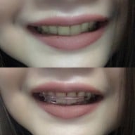 หลังจัดฟัน ฟันสวยขึ้นมากกกก 
