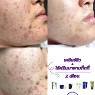 พี่กุ้งกดสิว มาดามกิ๊กกี้ by พี่ขวัญ สาขาจังหวัดลำพูน