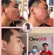 คลีโอ สกิน  Cleo Skin  แม่สาย Maesai
