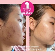 คลีโอ สกิน  Cleo Skin  แม่สาย Maesai