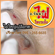 อาจารย์จันนาชลบุรี กำจัดไฝตามโหงวเฮ้ง ขี้แมลงวัน ติ่งเนื้อ เลเซอร์ สมุนไพร สี่แยกพลับพลา เสม็ดชลบุรี