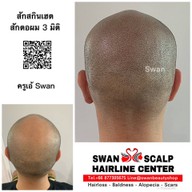 สักหัวล้านสักไรผม สักปิดรอยแผล SwanScalpHairlineCenter Bangkok