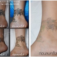 สัก ลบรอยสักรังสิต รังสิต
