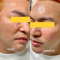 PPS Clinic (พีพีเอส คลินิกเวชกรรม) ด้านเมโสหน้าใส รักษาสิว เลเซอร์ โบท็อกซ์ ฟิลเลอร์ ลดริ้วรอย สเต็มเซลล์ ไฮฟู่ พิโคเลเซอร์ ครบวงจร ราชบุรี ราชบุรี