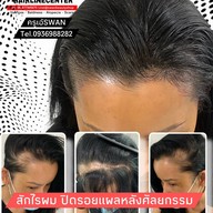สักหัวล้านสักไรผม สักปิดรอยแผล SwanScalpHairlineCenter Bangkok