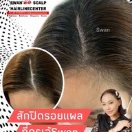 สักหัวล้านสักไรผม สักปิดรอยแผล SwanScalpHairlineCenter Bangkok