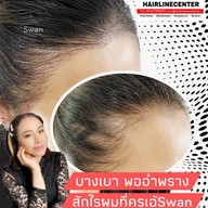 สักหัวล้านสักไรผม สักปิดรอยแผล SwanScalpHairlineCenter Bangkok