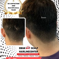 สักหัวล้านสักไรผม สักปิดรอยแผล SwanScalpHairlineCenter Bangkok