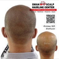 สักหัวล้านสักไรผม สักปิดรอยแผล SwanScalpHairlineCenter Bangkok