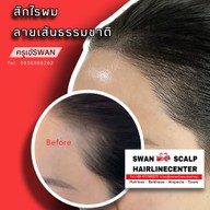 สักหัวล้านสักไรผม สักปิดรอยแผล SwanScalpHairlineCenter Bangkok