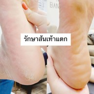 ตัดเล็บขบลำปาง LAMPANG