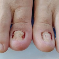 ตัดเล็บขบลำปาง LAMPANG