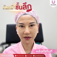 ยูอาร์คลินิก หมออาร์ม โคราช UR Clinic ดึงหน้า แก้หนังตาตก ตัดถุงใต้ตา ตัดเหนียง ตาสองชั้น ดูดไขมัน โคราช
