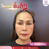 ยูอาร์คลินิก หมออาร์ม โคราช UR Clinic ดึงหน้า แก้หนังตาตก ตัดถุงใต้ตา ตัดเหนียง ตาสองชั้น ดูดไขมัน โคราช