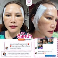 ยูอาร์คลินิก หมออาร์ม โคราช UR Clinic ดึงหน้า แก้หนังตาตก ตัดถุงใต้ตา ตัดเหนียง ตาสองชั้น ดูดไขมัน โคราช