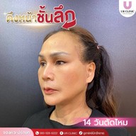 ยูอาร์คลินิก หมออาร์ม โคราช UR Clinic ดึงหน้า แก้หนังตาตก ตัดถุงใต้ตา ตัดเหนียง ตาสองชั้น ดูดไขมัน โคราช