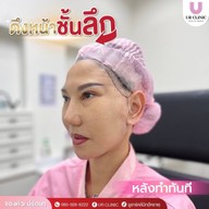 ยูอาร์คลินิก หมออาร์ม โคราช UR Clinic ดึงหน้า แก้หนังตาตก ตัดถุงใต้ตา ตัดเหนียง ตาสองชั้น ดูดไขมัน โคราช