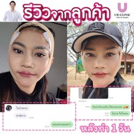 ยูอาร์คลินิก หมออาร์ม โคราช UR Clinic ดึงหน้า แก้หนังตาตก ตัดถุงใต้ตา ตัดเหนียง ตาสองชั้น ดูดไขมัน โคราช