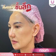 ยูอาร์คลินิก หมออาร์ม โคราช UR Clinic ดึงหน้า แก้หนังตาตก ตัดถุงใต้ตา ตัดเหนียง ตาสองชั้น ดูดไขมัน โคราช