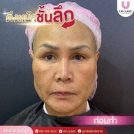 ยูอาร์คลินิก หมออาร์ม โคราช UR Clinic ดึงหน้า แก้หนังตาตก ตัดถุงใต้ตา ตัดเหนียง ตาสองชั้น ดูดไขมัน โคราช