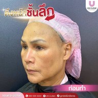 ยูอาร์คลินิก หมออาร์ม โคราช UR Clinic ดึงหน้า แก้หนังตาตก ตัดถุงใต้ตา ตัดเหนียง ตาสองชั้น ดูดไขมัน โคราช
