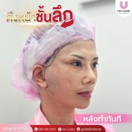ยูอาร์คลินิก หมออาร์ม โคราช UR Clinic ดึงหน้า แก้หนังตาตก ตัดถุงใต้ตา ตัดเหนียง ตาสองชั้น ดูดไขมัน โคราช