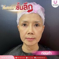 ยูอาร์คลินิก หมออาร์ม โคราช UR Clinic ดึงหน้า แก้หนังตาตก ตัดถุงใต้ตา ตัดเหนียง ตาสองชั้น ดูดไขมัน โคราช
