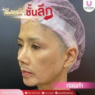 ยูอาร์คลินิก หมออาร์ม โคราช UR Clinic ดึงหน้า แก้หนังตาตก ตัดถุงใต้ตา ตัดเหนียง ตาสองชั้น ดูดไขมัน โคราช