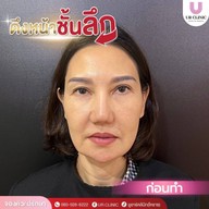 ยูอาร์คลินิก หมออาร์ม โคราช UR Clinic ดึงหน้า แก้หนังตาตก ตัดถุงใต้ตา ตัดเหนียง ตาสองชั้น ดูดไขมัน โคราช