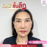 ยูอาร์คลินิก หมออาร์ม โคราช UR Clinic ดึงหน้า แก้หนังตาตก ตัดถุงใต้ตา ตัดเหนียง ตาสองชั้น ดูดไขมัน โคราช