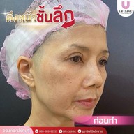 ยูอาร์คลินิก หมออาร์ม โคราช UR Clinic ดึงหน้า แก้หนังตาตก ตัดถุงใต้ตา ตัดเหนียง ตาสองชั้น ดูดไขมัน โคราช