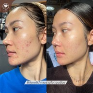 พี่กุ้งกดสิวสาขาโกสุมรวมใจ กดสิวดอนเมือง