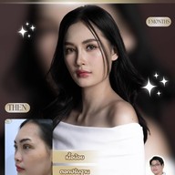 SB Clinic (สมบูรณ์การแพทย์)ขอนแก่น เสริมจมูกขอนแก่น สมบูรณ์การแพทย์