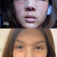 ALINE Clinic by หมอภูวิช ดึงหน้า เสริมจมูกโอเพ่น ตาสองชั้น โคราช