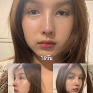 ALINE Clinic by หมอภูวิช ดึงหน้า เสริมจมูกโอเพ่น ตาสองชั้น โคราช