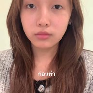 ALINE Clinic by หมอภูวิช ดึงหน้า เสริมจมูกโอเพ่น ตาสองชั้น โคราช