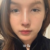 ALINE Clinic by หมอภูวิช ดึงหน้า เสริมจมูกโอเพ่น ตาสองชั้น โคราช