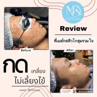 พี่กุ้งกดสิวสาขาโกสุมรวมใจ กดสิวดอนเมือง