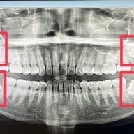 Dentalwise Clinic : เดนทอลไวส์คลินิก Invisalign Diamond Provider  ทองหล่อ