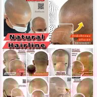 สักหัวล้านสักไรผม สักปิดรอยแผล SwanScalpHairlineCenter Bangkok