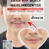 สักหัวล้านสักไรผม สักปิดรอยแผล SwanScalpHairlineCenter Bangkok